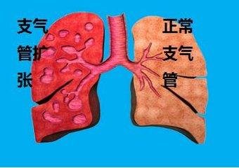 夏天睡地上会引起支气管扩...