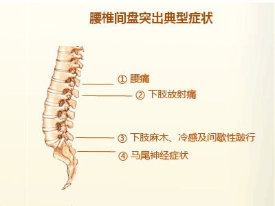 腰间盘突出按什么穴位？